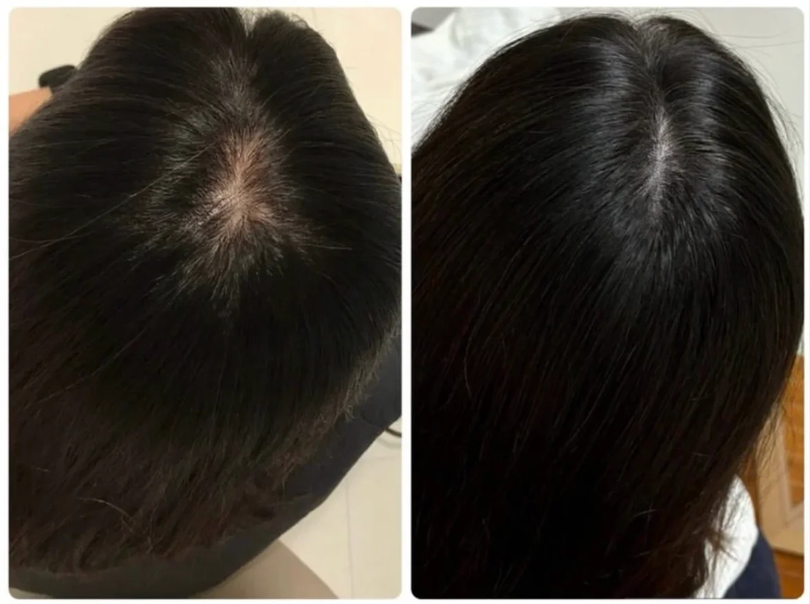薄毛・ヘアルプデザインの施術事例8