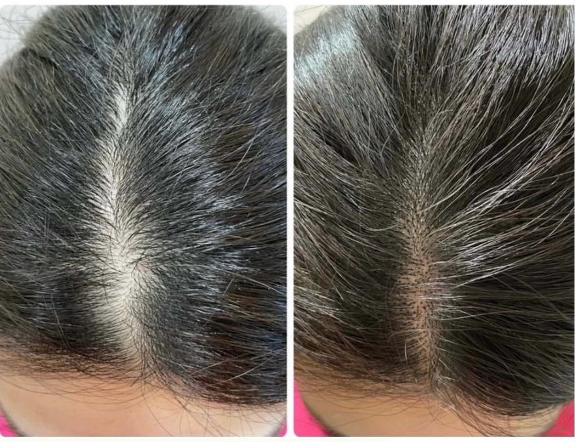 薄毛・ヘアルプデザインの施術事例14